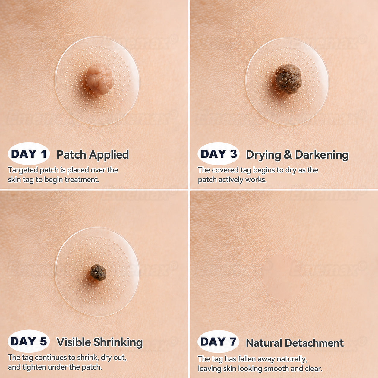 𝐄𝐦𝐞𝐦𝐚𝐱®𝟐-𝐢𝐧-𝟏 𝐌𝐢𝐜𝐫𝐨𝐧𝐞𝐞𝐝𝐥𝐞 & 𝐇𝐲𝐝𝐫𝐨𝐜𝐨𝐥𝐥𝐨𝐢𝐝 𝐌𝐨𝐥𝐞 𝐑𝐞𝐦𝐨𝐯𝐚𝐥 𝐏𝐚𝐭𝐜𝐡(Zero Pain, Zero 𝐒𝐜𝐚𝒓𝒔 patch)💪