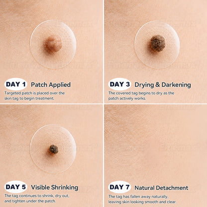 𝐄𝐦𝐞𝐦𝐚𝐱®𝟐-𝐢𝐧-𝟏 𝐌𝐢𝐜𝐫𝐨𝐧𝐞𝐞𝐝𝐥𝐞 & 𝐇𝐲𝐝𝐫𝐨𝐜𝐨𝐥𝐥𝐨𝐢𝐝 𝐌𝐨𝐥𝐞 𝐑𝐞𝐦𝐨𝐯𝐚𝐥 𝐏𝐚𝐭𝐜𝐡(Zero Pain, Zero 𝐒𝐜𝐚𝒓𝒔 patch)💪