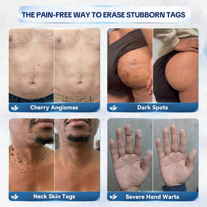 🍀𝐏𝐢𝐜𝐝𝐨® 7-𝐃𝐚𝐲 𝐒𝐤𝐢𝐧 𝐓𝐚𝐠 & 𝐒𝐩𝐨𝐭 𝐄𝐫𝐚𝐬𝐞𝐫 𝐂𝐫𝐞𝐚𝐦🩵 (Zero Pain, Zero 𝐒𝐜𝐚𝐫𝐬 Formula) 💪