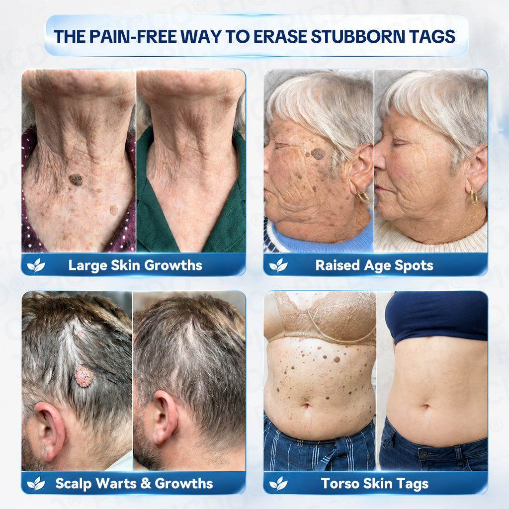 🍀𝐏𝐢𝐜𝐝𝐨® 7-𝐃𝐚𝐲 𝐒𝐤𝐢𝐧 𝐓𝐚𝐠 & 𝐒𝐩𝐨𝐭 𝐄𝐫𝐚𝐬𝐞𝐫 𝐂𝐫𝐞𝐚𝐦🩵 (Zero Pain, Zero 𝐒𝐜𝐚𝐫𝐬 Formula) 💪