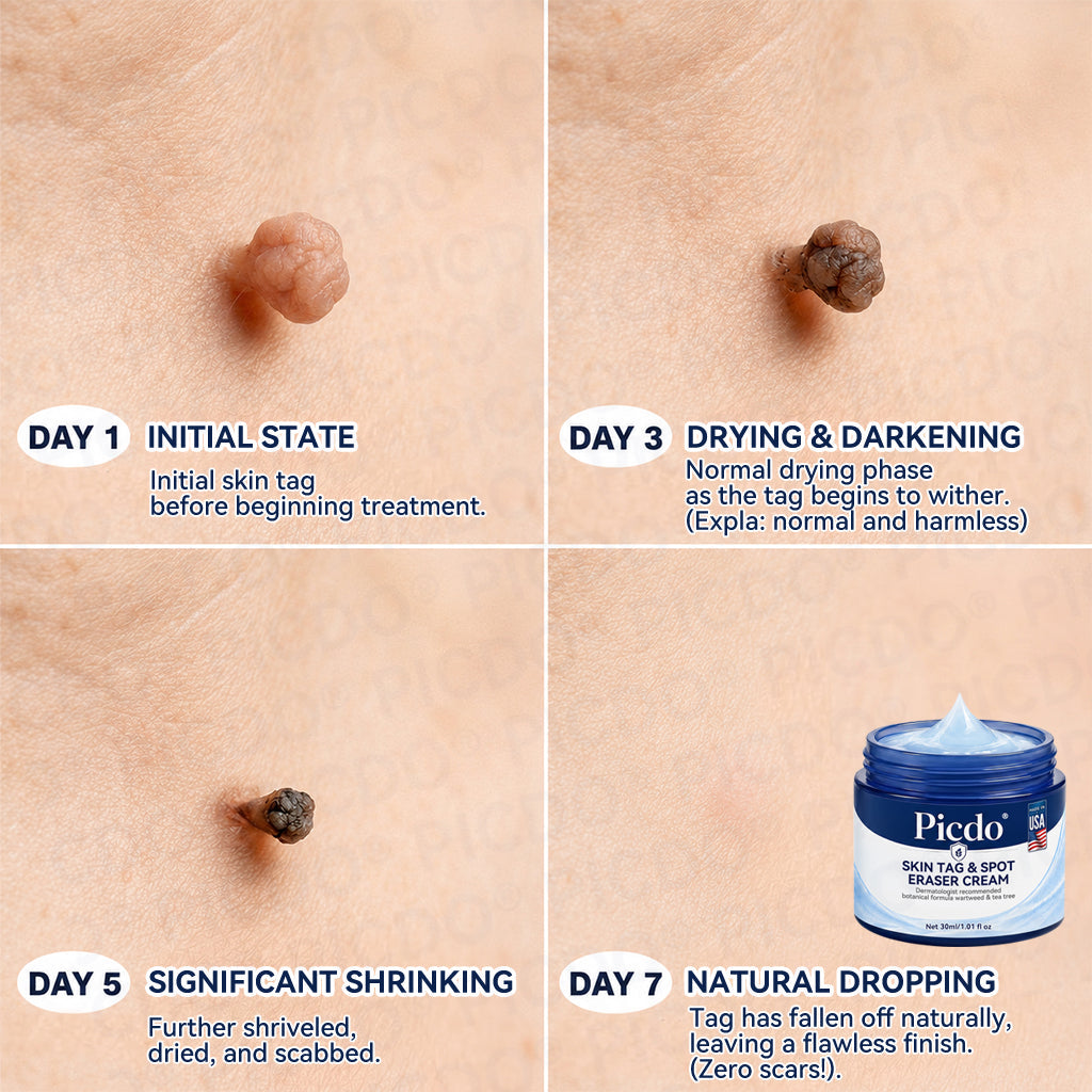 🍀𝐏𝐢𝐜𝐝𝐨® 7-𝐃𝐚𝐲 𝐒𝐤𝐢𝐧 𝐓𝐚𝐠 & 𝐒𝐩𝐨𝐭 𝐄𝐫𝐚𝐬𝐞𝐫 𝐂𝐫𝐞𝐚𝐦🩵 (Zero Pain, Zero 𝐒𝐜𝐚𝐫𝐬 Formula) 💪
