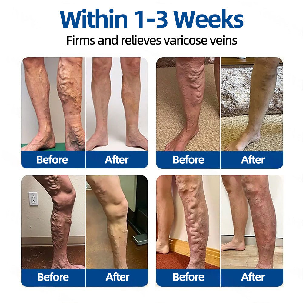 👩‍⚕️🎁 𝐅𝐥𝐨𝐫𝐢𝐬𝐦𝐚® ✅ 𝐕𝐞𝐢𝐧𝐓𝐚𝐫𝐠𝐞𝐭 𝐌𝐢𝐜𝐫𝐨𝐧𝐞𝐞𝐝𝐥𝐞 𝐏𝐚𝐭𝐜𝐡⚡Instant Relief, Long-Term Results
