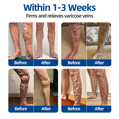 👩‍⚕️🎁 𝐅𝐥𝐨𝐫𝐢𝐬𝐦𝐚® ✅ 𝐕𝐞𝐢𝐧𝐓𝐚𝐫𝐠𝐞𝐭 𝐌𝐢𝐜𝐫𝐨𝐧𝐞𝐞𝐝𝐥𝐞 𝐏𝐚𝐭𝐜𝐡⚡Instant Relief, Long-Term Results